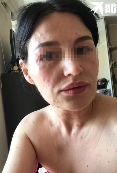 Жертвы новосибирских косметологов рассказали свои истории и показали фото Жертвы новосибирских косметологов рассказали свои истории и показали фото